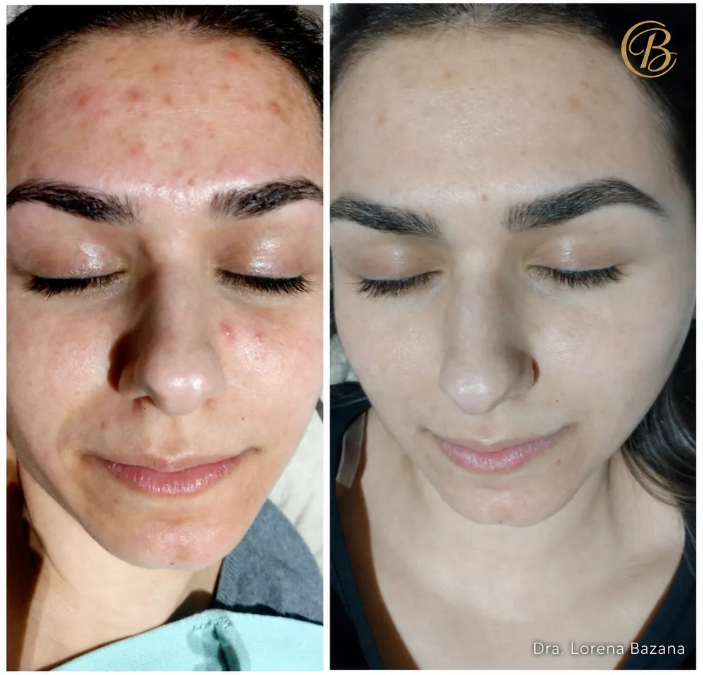 Antes e depois de limpeza de pele: redução de acne e vermelhidão na testa e no rosto