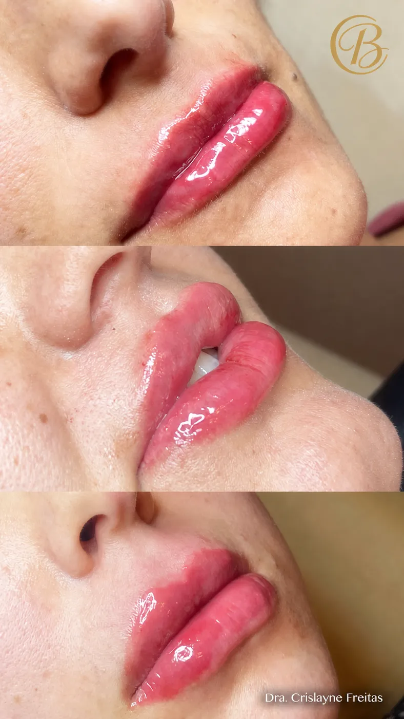 Resultados de preenchimento labial em diferentes ângulos