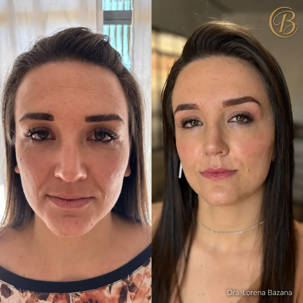 Antes e depois de harmonização facial: pele mais firme e traços equilibrados