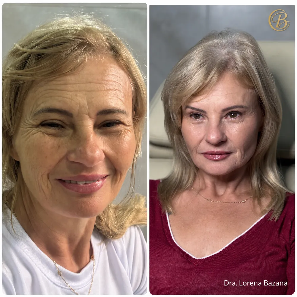 Antes e depois de rejuvenescimento em pele madura: rugas mais suaves e viço renovado