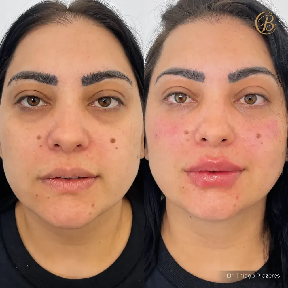 Antes e depois de harmonização: olheiras suavizadas e lábios mais definidos
