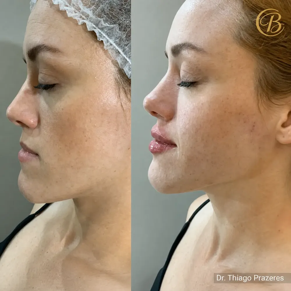 Antes e depois de contorno facial em perfil: mandíbula mais definida